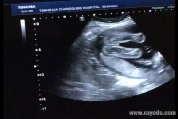 宁波阿尔法怀孕中心做试管婴儿多少钱，3万元够吗？