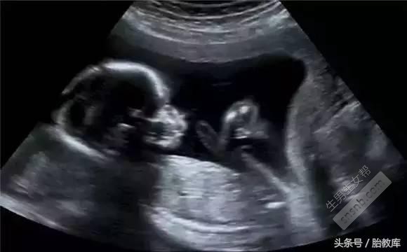 超声波可以显示婴儿是男是女，这种方法被认为是最准确的!