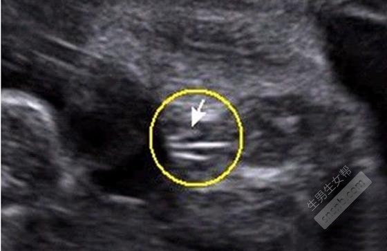 4D片上的男女线索，男婴的原始超声图是这样的。