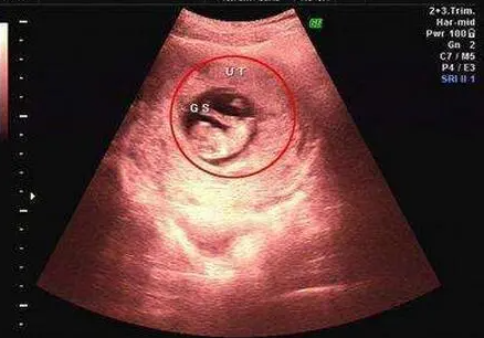 查看婴儿出生时是男是女的超声波表_B 查看婴儿出生时是男是女的超声波表。